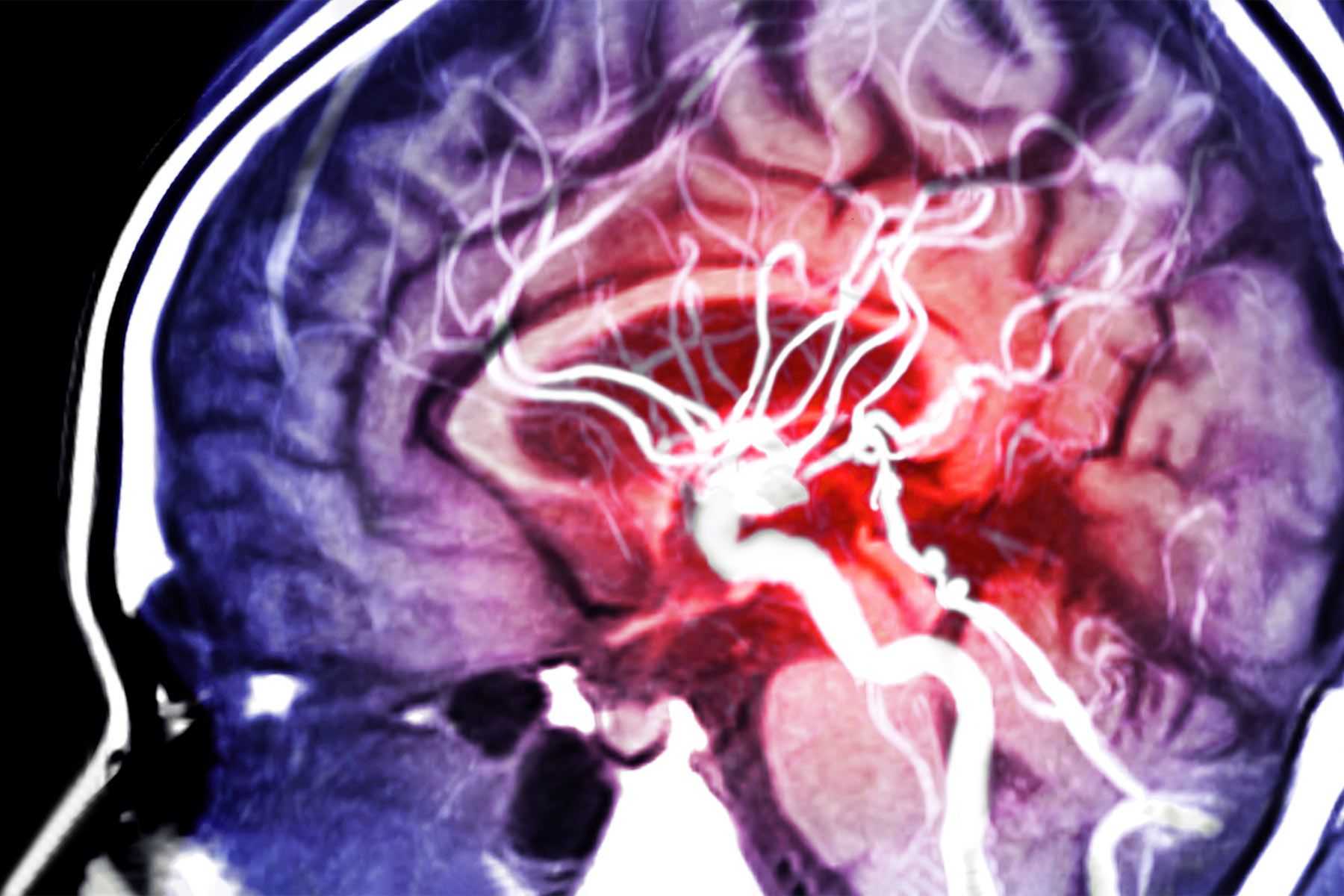 Information Anchor’s Stroke on Reside TV a Reminder: Know the Indicators