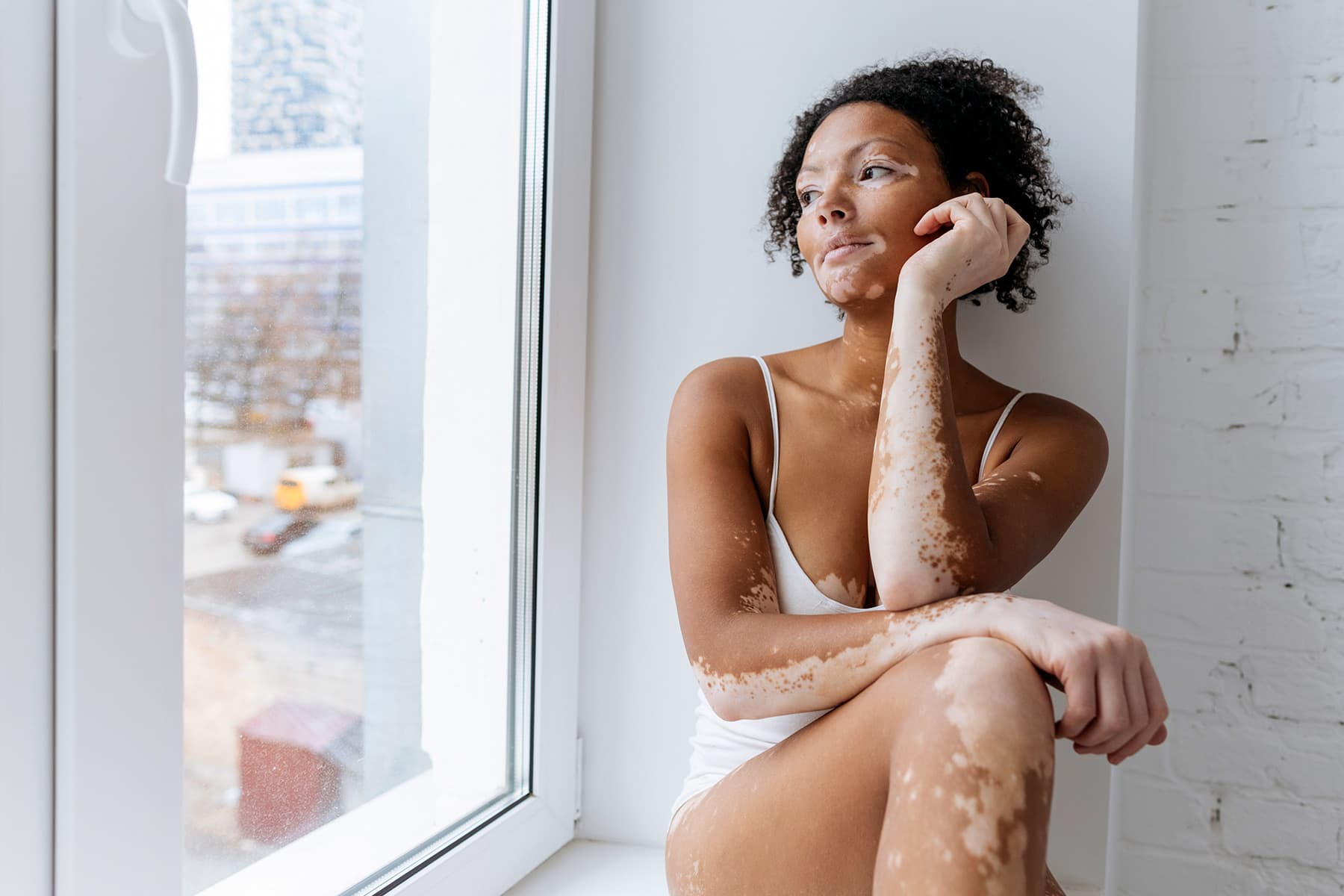 Dealing with the Doubt of Vitiligo Dealing with the Doubt of Vitiligo