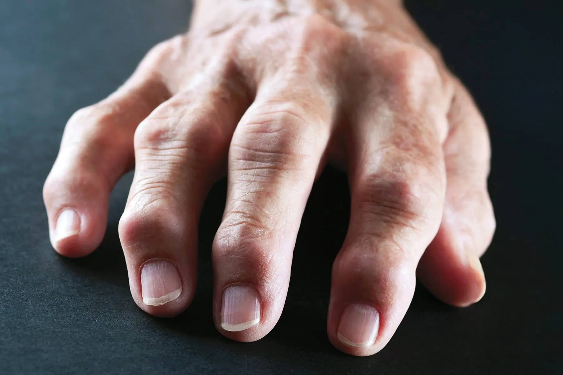 Docs Attempt for Faster Analysis of Rheumatoid Arthritis Docs Attempt for Faster Analysis of Rheumatoid Arthritis