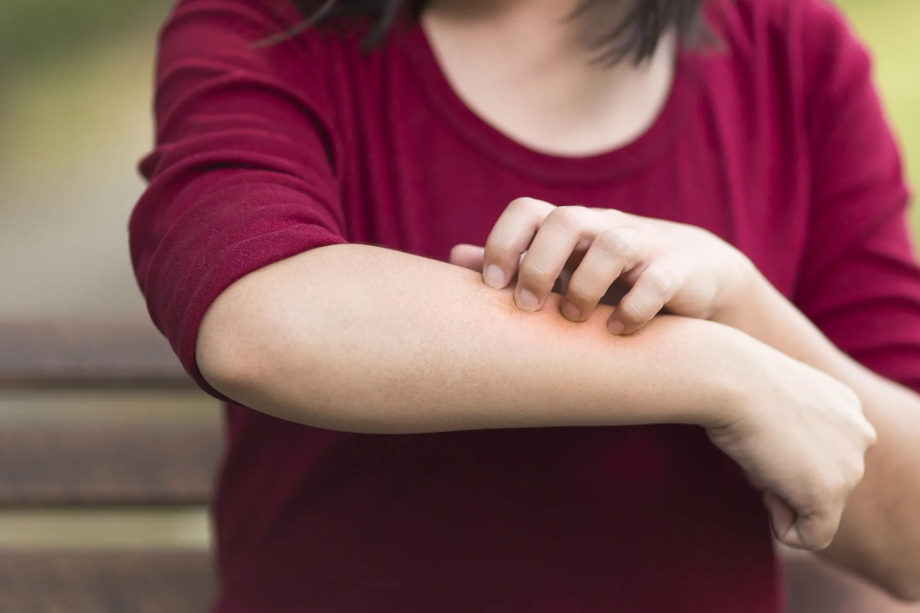 Atopic Dermatitis: Each day Life Atopic Dermatitis: Each day Life