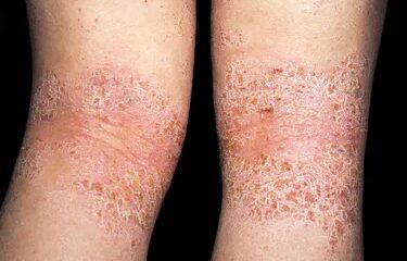 Is It Dry Pores and skin or Atopic Dermatitis?