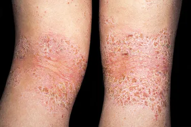 Is It Dry Pores and skin or Atopic Dermatitis?