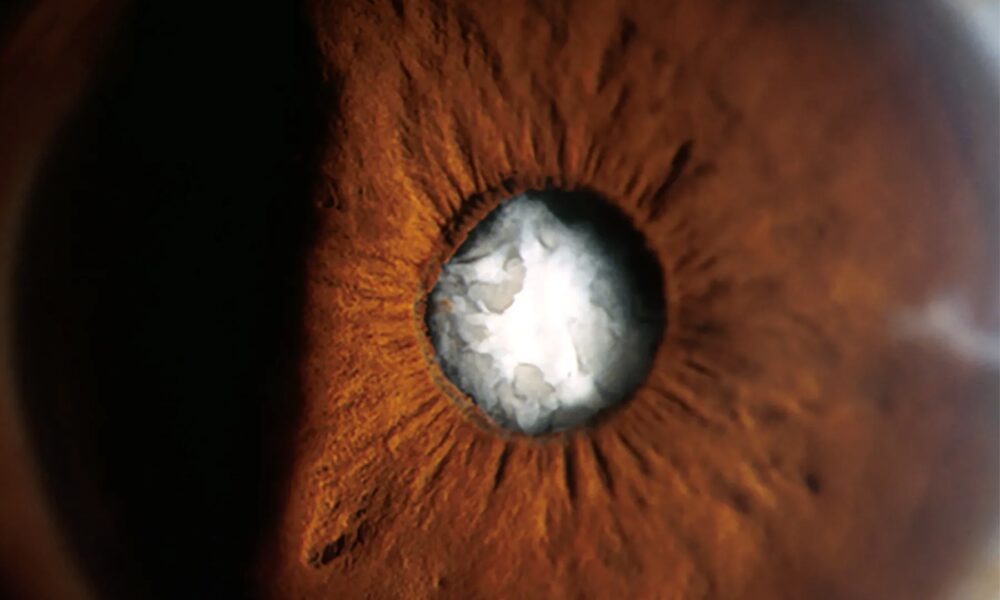 Cataract Surgical procedure Tough for These With Previous Radial Keratotomy