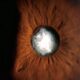 Cataract Surgical procedure Tough for These With Previous Radial Keratotomy