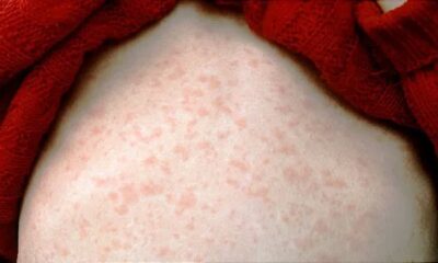 Might U.S. Measles Circumstances Break a Document This Yr? What to Know