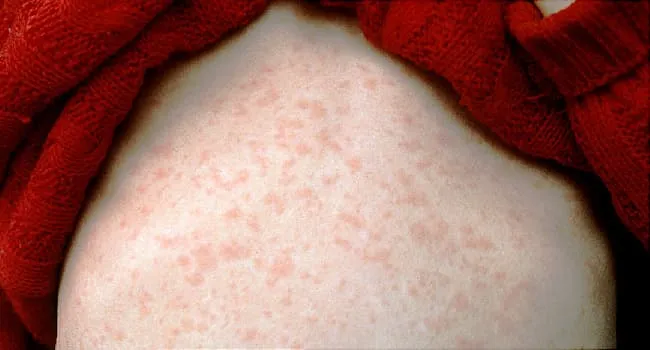Might U.S. Measles Circumstances Break a Document This Yr? What to Know
