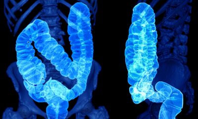 Behind the Spike in Colorectal Most cancers Amongst Younger People
