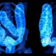 Behind the Spike in Colorectal Most cancers Amongst Younger People Behind the Spike in Colorectal Most cancers Amongst Younger People