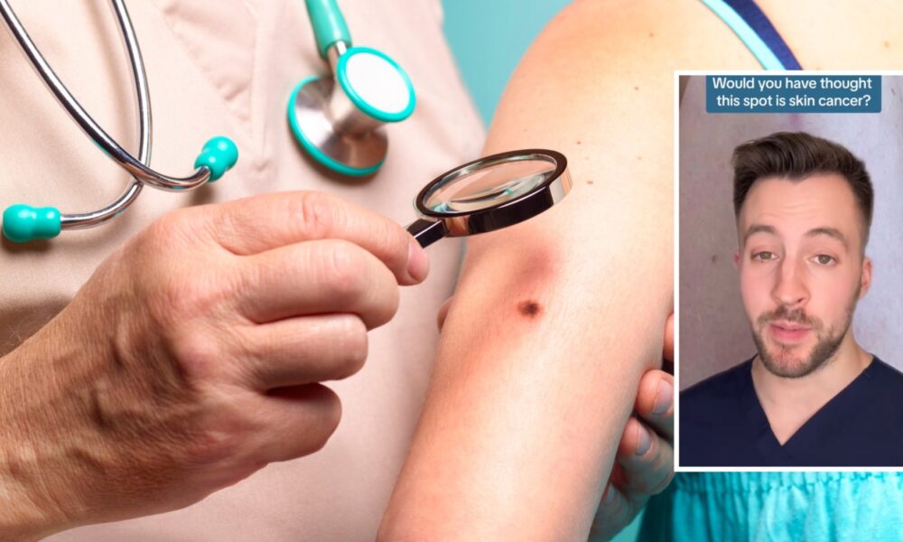 Dermatologist highlights one uncommon pores and skin most cancers symptom you want to pay attention to