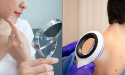 Physician shares warning indicators a standard ‘pimple’ may very well be lethal pores and skin most cancers