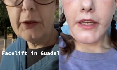 TikToker Michelle Wooden’s Facelift Pictures: Earlier than and After