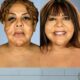 Botched Plastic Surgical procedure Earlier than and After Pics Botched Plastic Surgical procedure Earlier than and After Pics